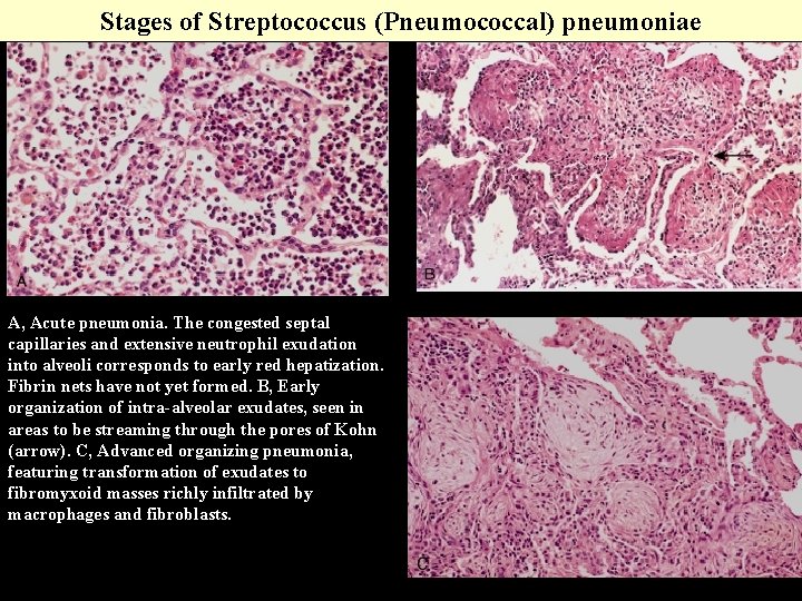 Stages of Streptococcus (Pneumococcal) pneumoniae A, Acute pneumonia. The congested septal capillaries and extensive Stages of Streptococcus (Pneumococcal) pneumoniae A, Acute pneumonia. The congested septal capillaries and extensive