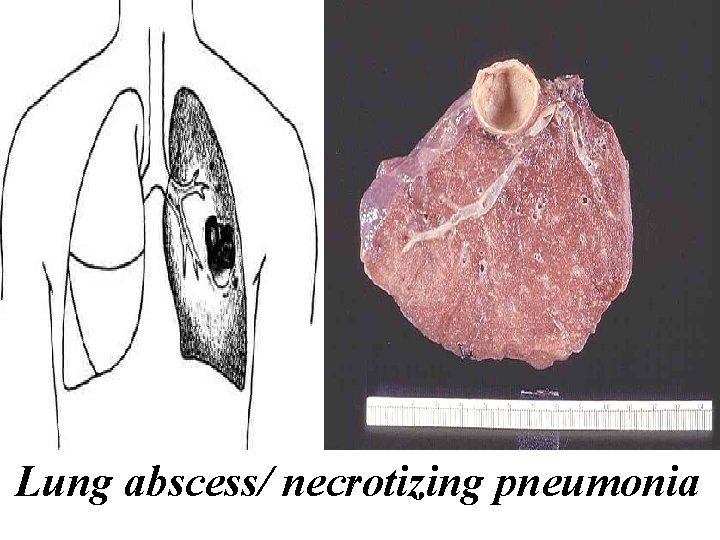 Lung abscess/ necrotizing pneumonia Lung abscess/ necrotizing pneumonia