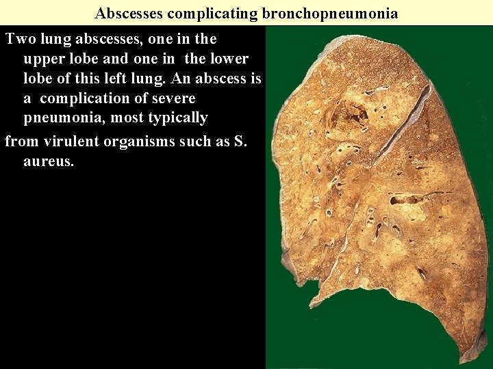 Abscesses complicating bronchopneumonia Two lung abscesses, one in the upper lobe and one in Abscesses complicating bronchopneumonia Two lung abscesses, one in the upper lobe and one in