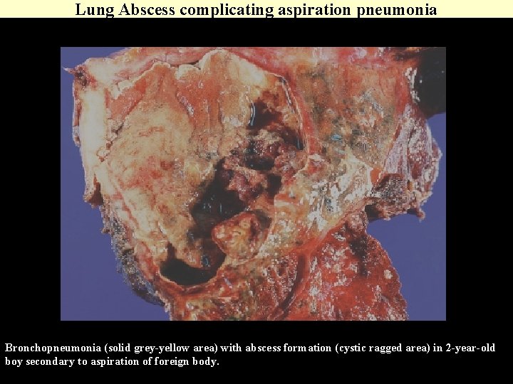 Lung Abscess complicating aspiration pneumonia Bronchopneumonia (solid grey-yellow area) with abscess formation (cystic ragged Lung Abscess complicating aspiration pneumonia Bronchopneumonia (solid grey-yellow area) with abscess formation (cystic ragged
