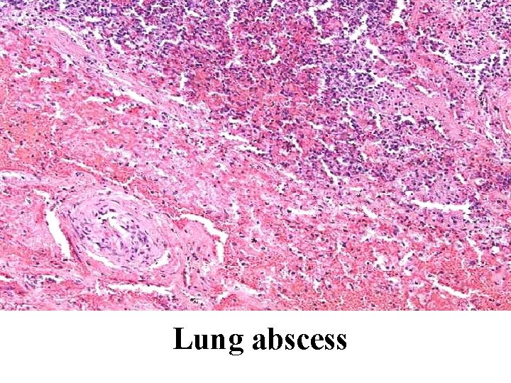 Lung abscess Lung abscess