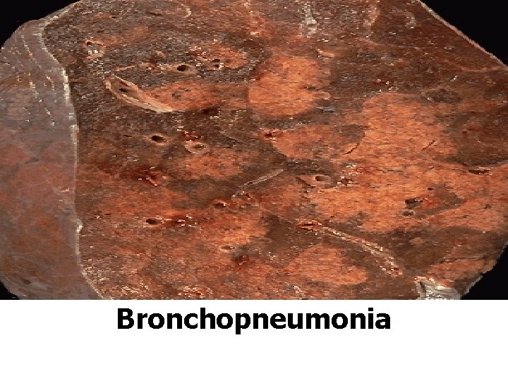 Bronchopneumonia Bronchopneumonia