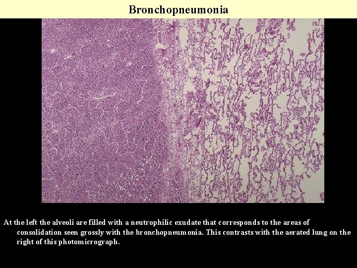 Bronchopneumonia At the left the alveoli are filled with a neutrophilic exudate that corresponds Bronchopneumonia At the left the alveoli are filled with a neutrophilic exudate that corresponds