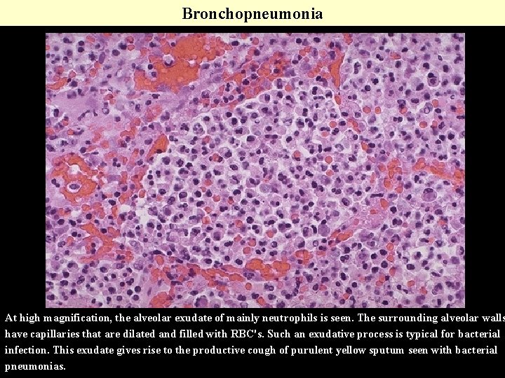 Bronchopneumonia At high magnification, the alveolar exudate of mainly neutrophils is seen. The surrounding Bronchopneumonia At high magnification, the alveolar exudate of mainly neutrophils is seen. The surrounding