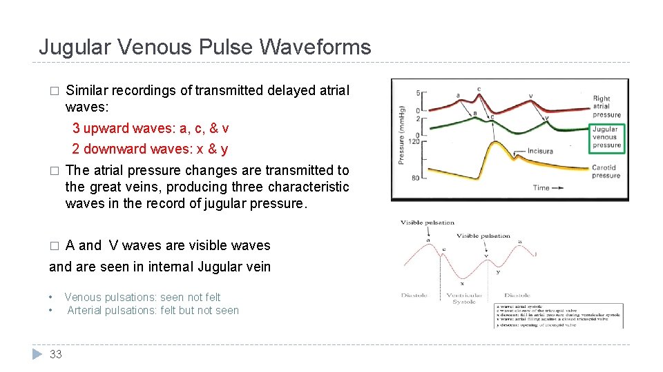 Jugular Venous Pulse Waveforms � Similar recordings of transmitted delayed atrial waves: 3 upward