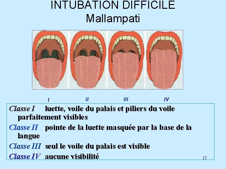 INTUBATION DIFFICILE Mallampati I II IV Classe I luette, voile du palais et piliers