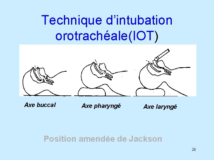 Technique d’intubation orotrachéale(IOT) Axe buccal Axe pharyngé Axe laryngé Position amendée de Jackson 26