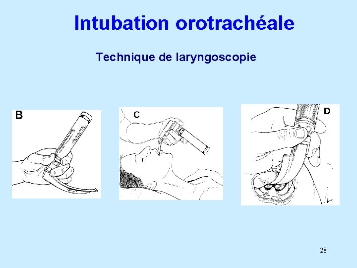 Intubation orotrachéale Technique de laryngoscopie 28 