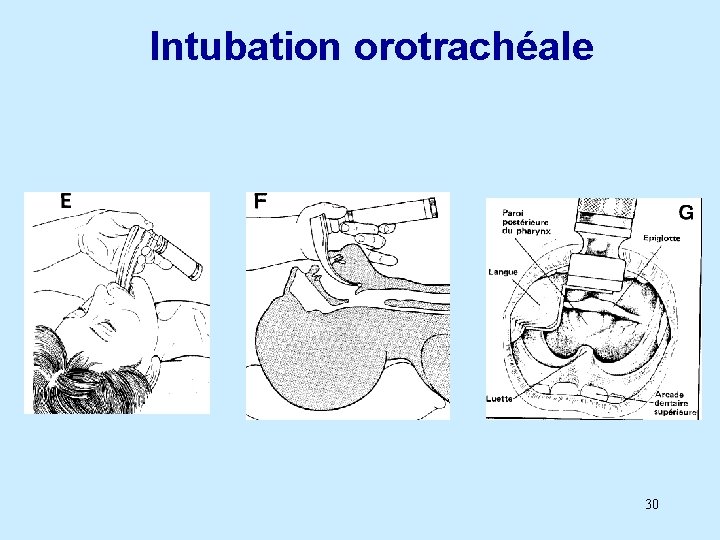 Intubation orotrachéale 30 