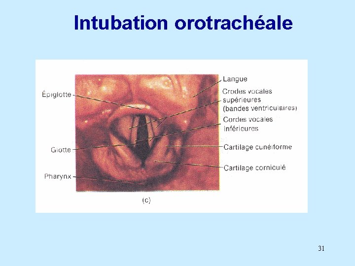 Intubation orotrachéale 31 