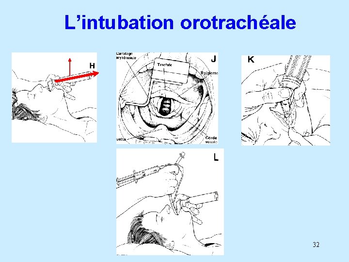 L’intubation orotrachéale 32 