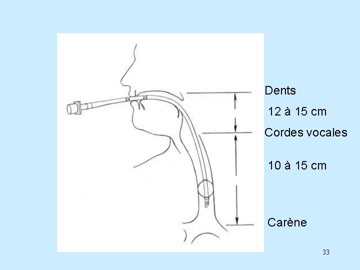 Dents 12 à 15 cm Cordes vocales 10 à 15 cm Carène 33 