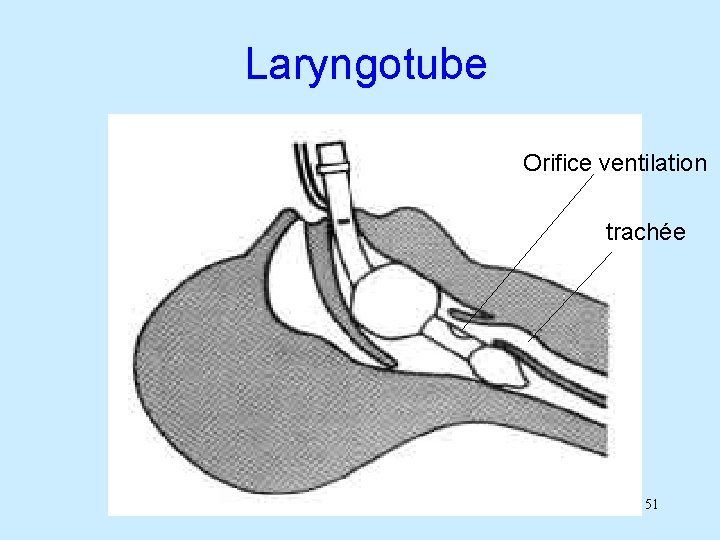 Laryngotube Orifice ventilation trachée 51 