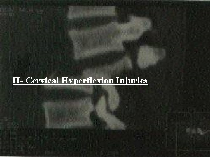 II- Cervical Hyperflexion Injuries 