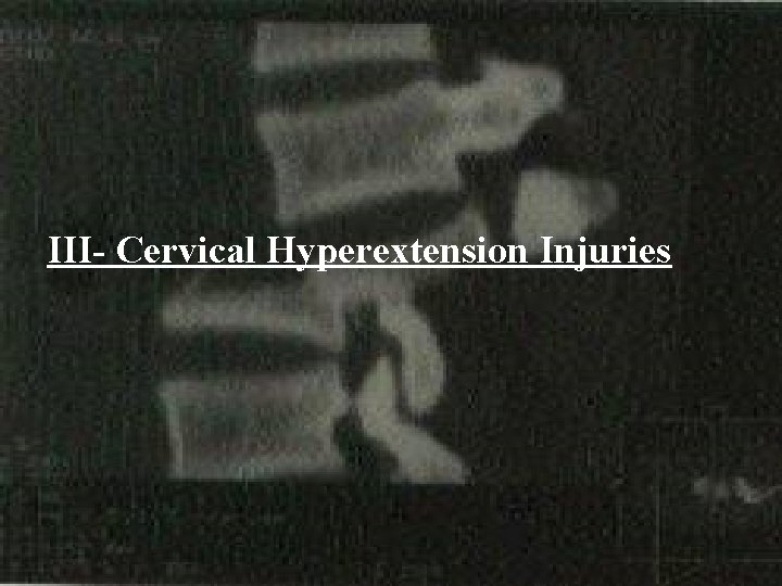 III- Cervical Hyperextension Injuries 