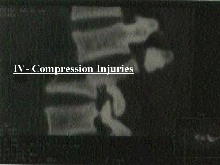 IV- Compression Injuries 