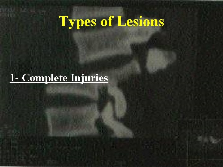 Types of Lesions 1 - Complete Injuries 