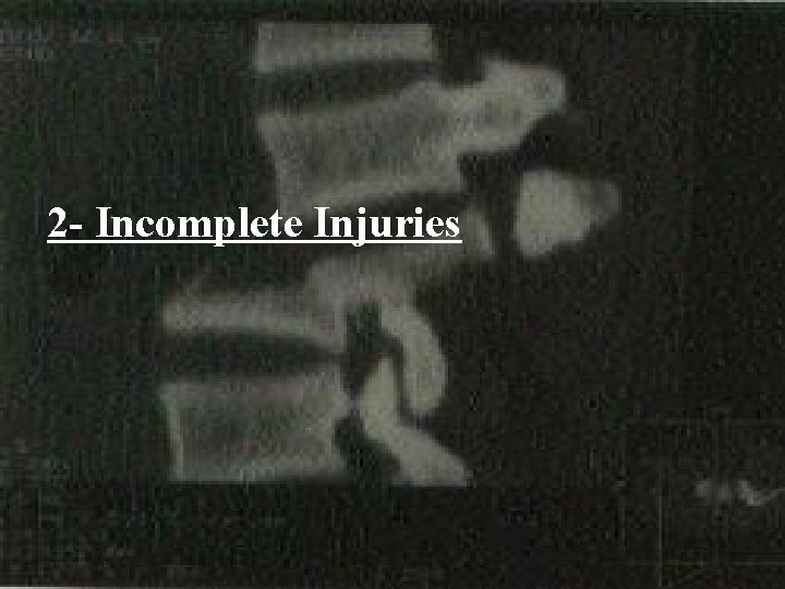 2 - Incomplete Injuries 