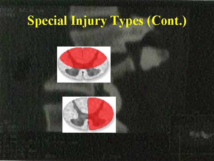 Special Injury Types (Cont. ) 