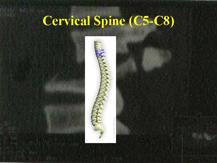 Cervical Spine (C 5 -C 8) 