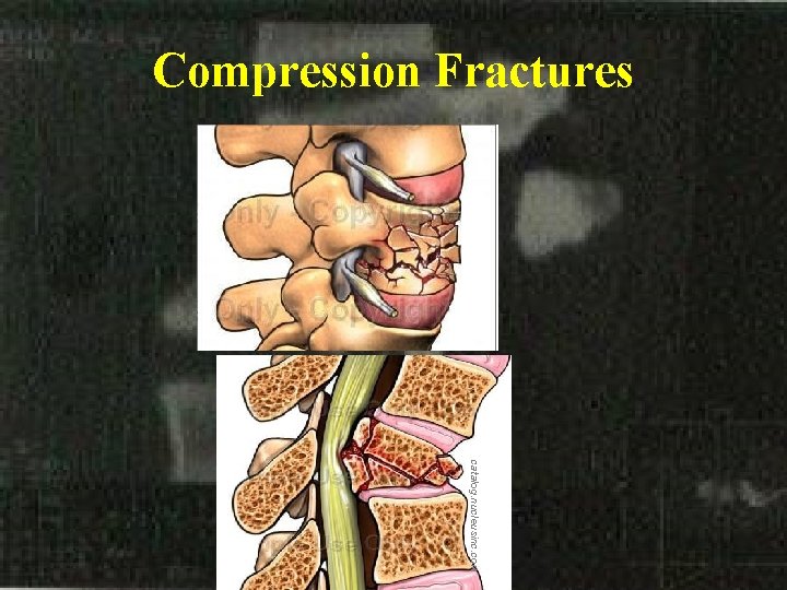 Compression Fractures catalog. nucleusinc. com 