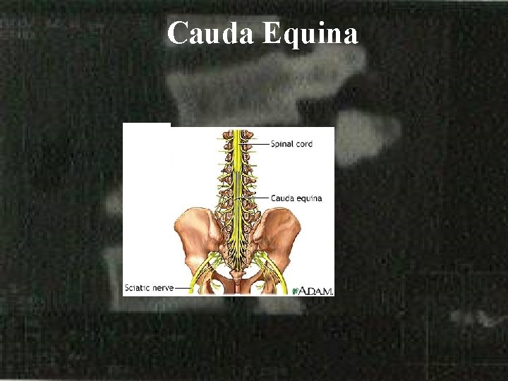 Cauda Equina 