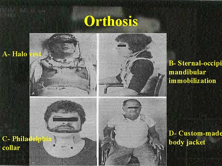 Orthosis A- Halo vest B- Sternal-occipit mandibular immobilization C- Philadelphia collar D- Custom-made body