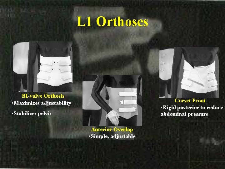 L 1 Orthoses BI-valve Orthosis • Maximizes adjustability Corset Front • Rigid posterior to