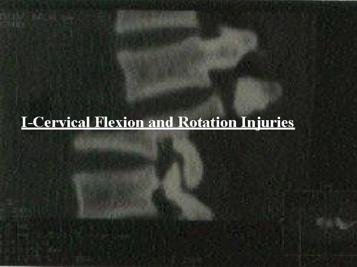 I-Cervical Flexion and Rotation Injuries 