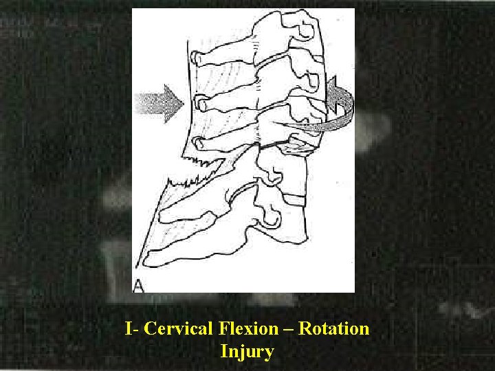 I- Cervical Flexion – Rotation Injury 