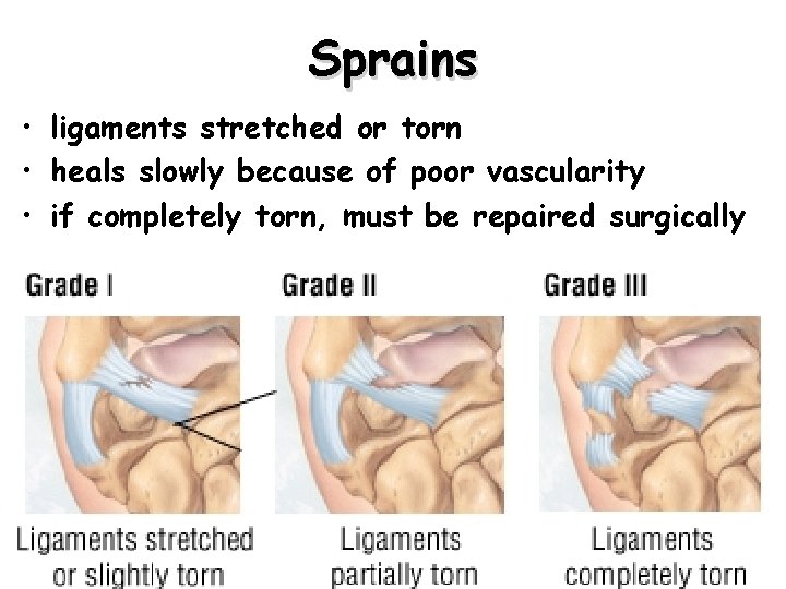 Sprains • ligaments stretched or torn • heals slowly because of poor vascularity •