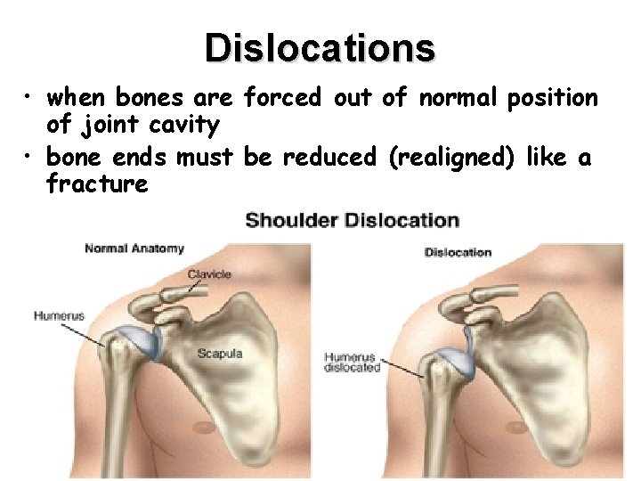 Dislocations • when bones are forced out of normal position of joint cavity •