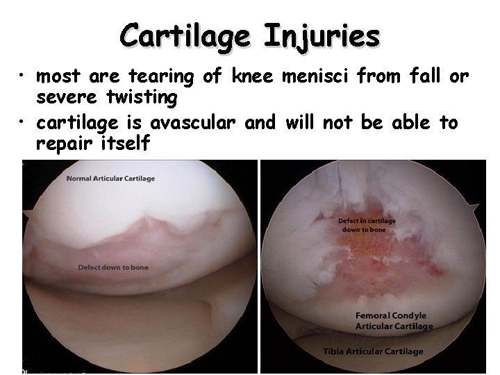 Cartilage Injuries • most are tearing of knee menisci from fall or severe twisting