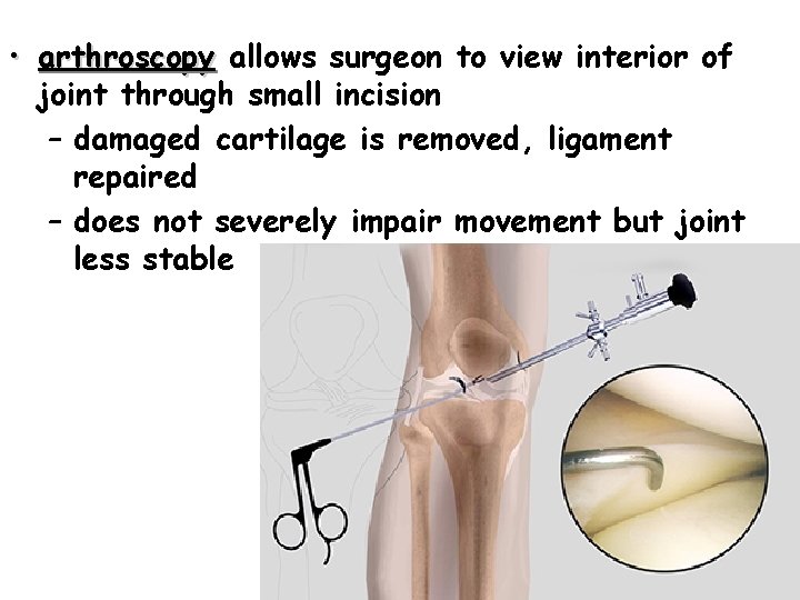  • arthroscopy allows surgeon to view interior of joint through small incision –