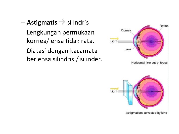 – Astigmatis silindris Lengkungan permukaan kornea/lensa tidak rata. Diatasi dengan kacamata berlensa silindris /