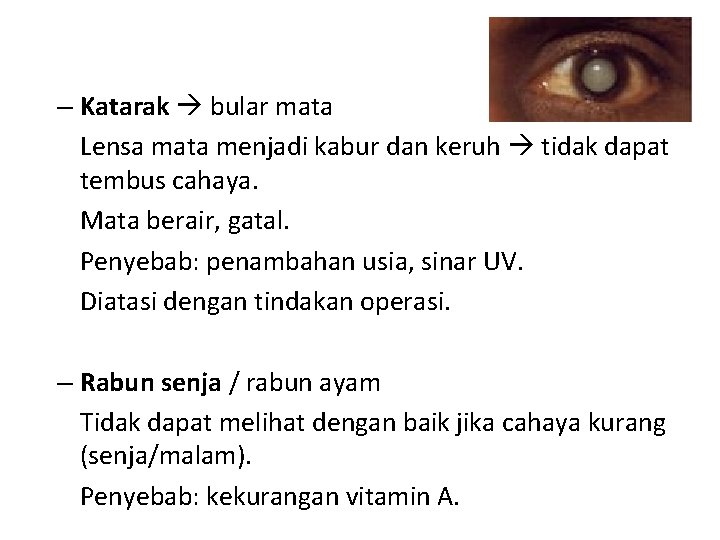 – Katarak bular mata Lensa mata menjadi kabur dan keruh tidak dapat tembus cahaya.