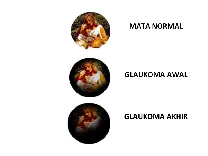 MATA NORMAL GLAUKOMA AWAL GLAUKOMA AKHIR 