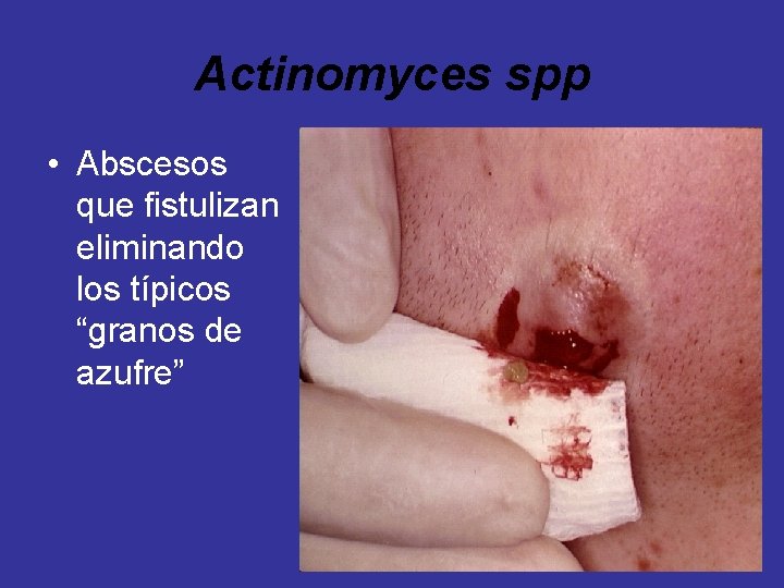 Actinomyces spp • Abscesos que fistulizan eliminando los típicos “granos de azufre” 