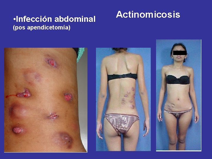  • Infección abdominal (pos apendicetomía) Actinomicosis 