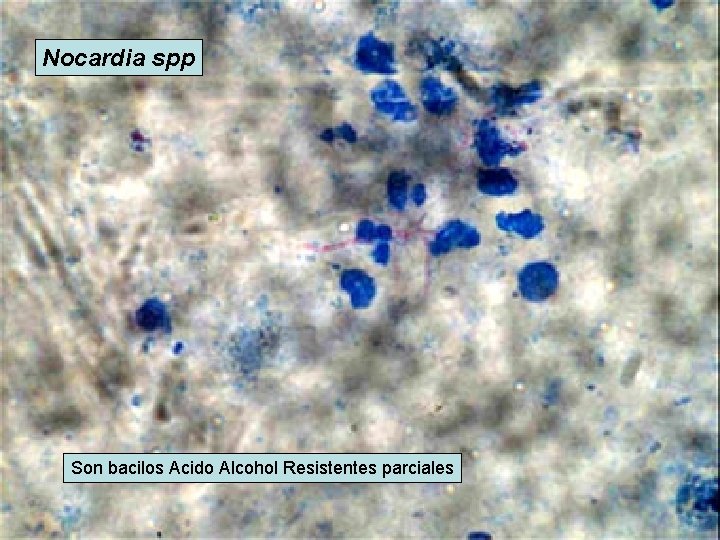 Nocardia spp Son bacilos Acido Alcohol Resistentes parciales 