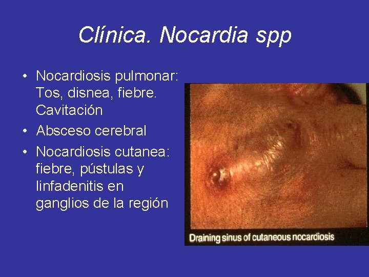 Clínica. Nocardia spp • Nocardiosis pulmonar: Tos, disnea, fiebre. Cavitación • Absceso cerebral •