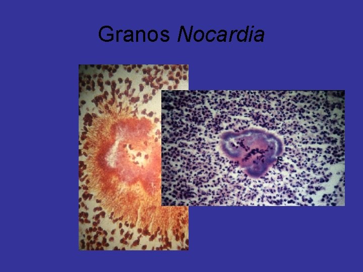 Granos Nocardia 