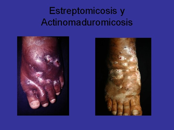 Estreptomicosis y Actinomaduromicosis 