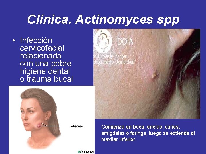 Clínica. Actinomyces spp • Infección cervicofacial relacionada con una pobre higiene dental o trauma