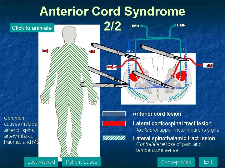 Anterior Cord Syndrome Click to animate 2/2 UMN DRG R Anterior cord lesion Common