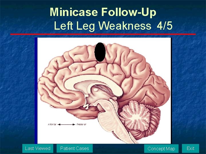 Minicase Follow-Up Left Leg Weakness 4/5 Last Viewed Patient Cases Concept Map Exit 