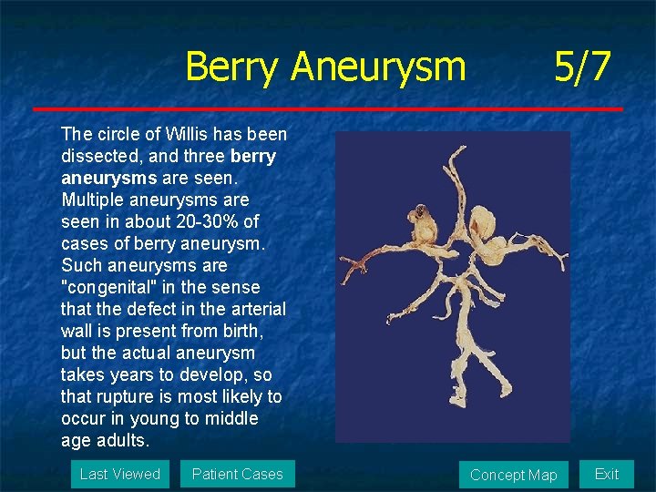 Berry Aneurysm 5/7 The circle of Willis has been dissected, and three berry aneurysms
