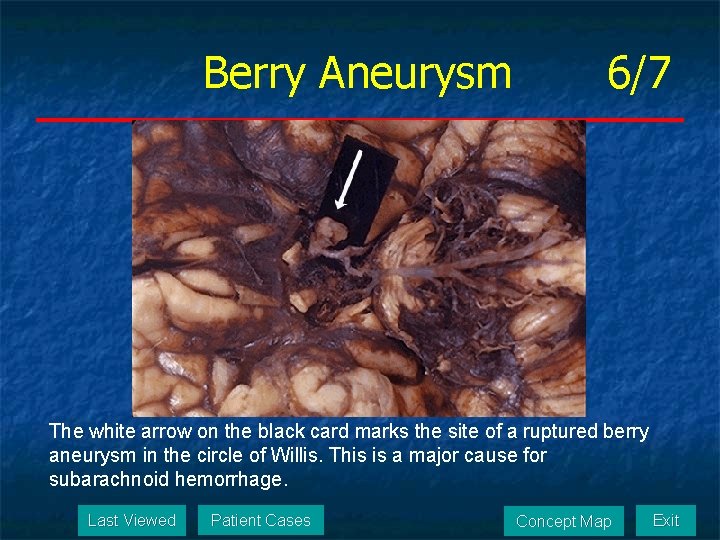 Berry Aneurysm 6/7 The white arrow on the black card marks the site of