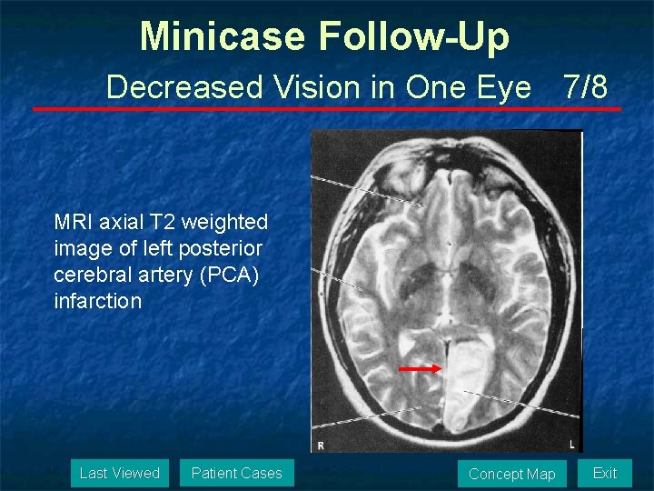 Minicase Follow-Up Decreased Vision in One Eye 7/8 MRI axial T 2 weighted image