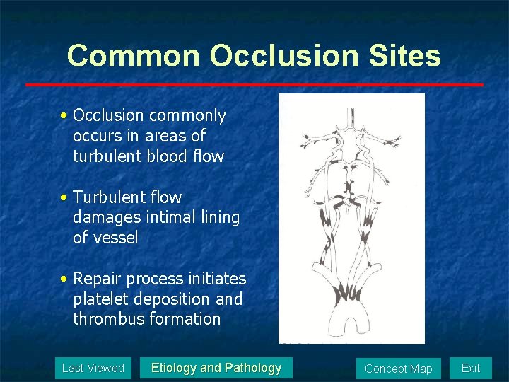Common Occlusion Sites • Occlusion commonly occurs in areas of turbulent blood flow •